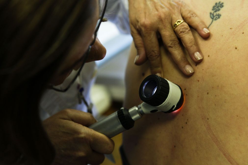 Quase 100 suspeitas de cancro de pele no rastreio nacional de 2016