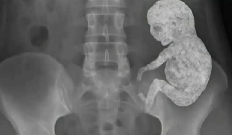 O mistério do bebé de pedra: Quando o próprio corpo mumifica a vida