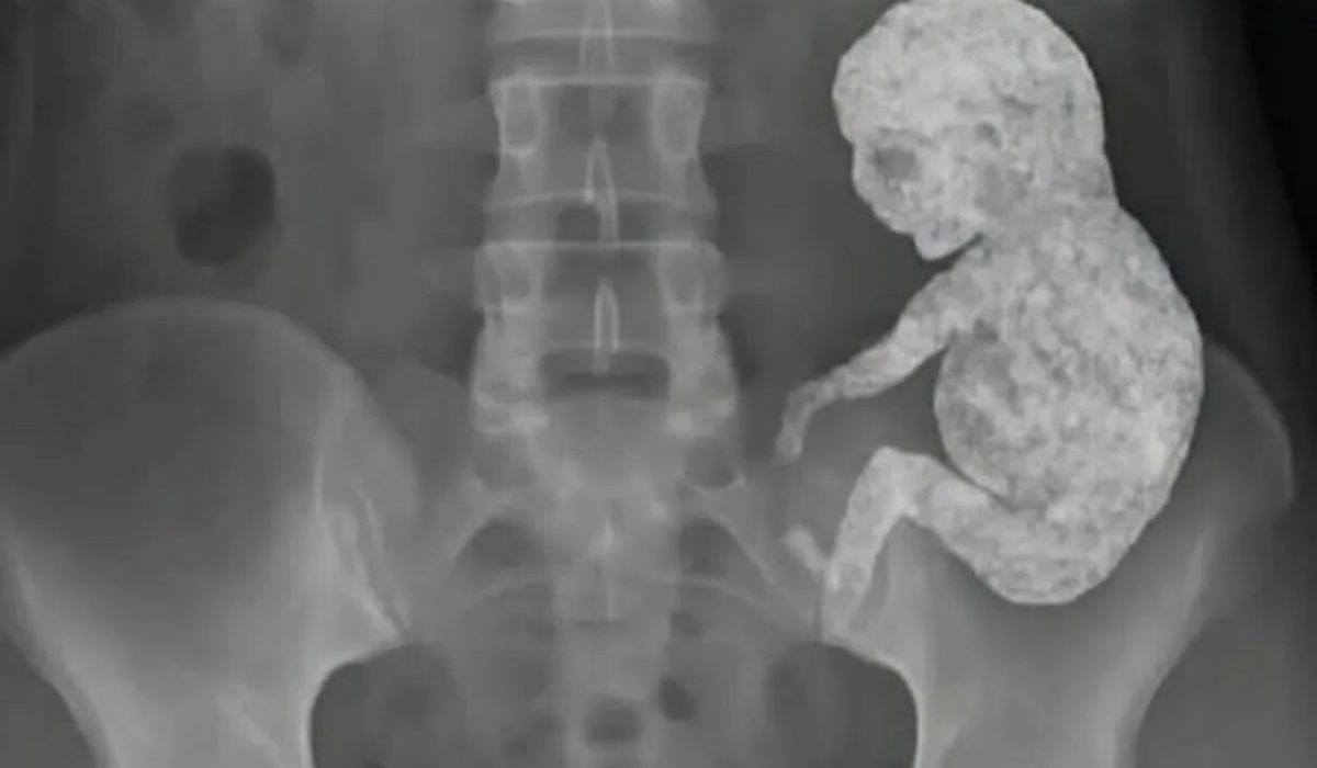 O mistério do bebé de pedra: Quando o próprio corpo mumifica a vida
