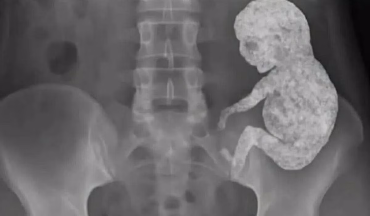 O mistério do bebé de pedra: Quando o próprio corpo mumifica a vida