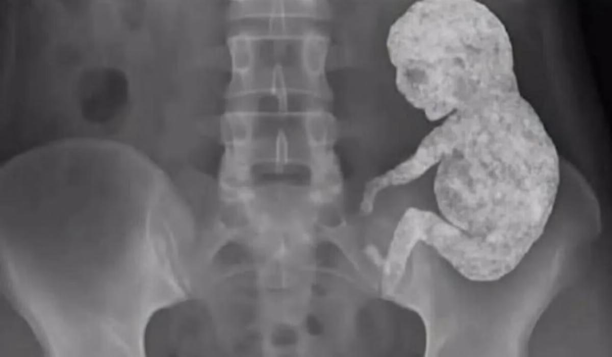 O mistério do bebé de pedra: Quando o próprio corpo mumifica a vida